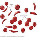 sickle-cell-anemia