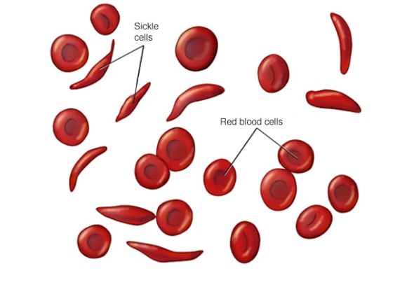 sickle-cell-anemia